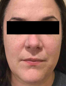 Laser Skin Resurfacing Before and After Pictures Bucks County, PA and Hunterdon County, NJ