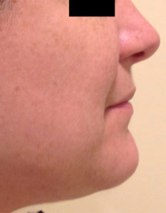 Laser Skin Resurfacing Before and After Pictures Bucks County, PA and Hunterdon County, NJ