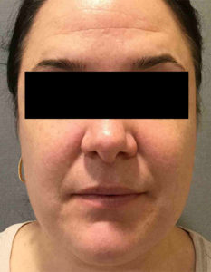 Laser Skin Resurfacing Before and After Pictures Bucks County, PA and Hunterdon County, NJ