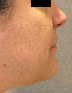 Laser Skin Resurfacing Before and After Pictures Bucks County, PA, and Hunterdon County, NJ