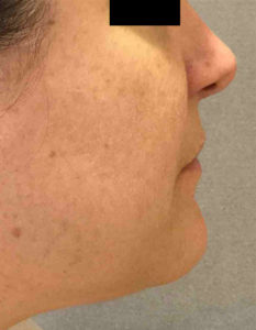 Laser Skin Resurfacing Before and After Pictures Bucks County, PA and Hunterdon County, NJ