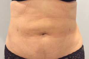 Liposuction Before and After Pictures Bucks County, PA, and Hunterdon County, NJ
