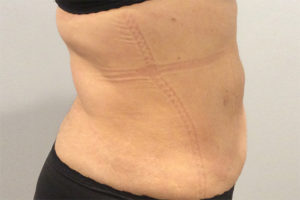 Liposuction Before and After Pictures Bucks County, PA and Hunterdon County, NJ