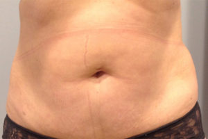 Liposuction Before and After Pictures Bucks County, PA and Hunterdon County, NJ
