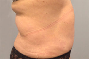 Liposuction Before and After Pictures Bucks County, PA and Hunterdon County, NJ