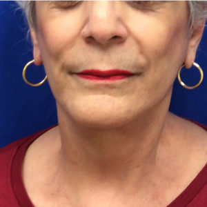Facelift Before and After Pictures Bucks County, PA and Hunterdon County, NJ