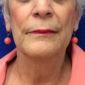 Facelift Before and After Pictures Bucks County, PA and Hunterdon County, NJ