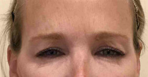 Botox®Before and After in Bucks County, PA, and Hunterdon County, NJ
