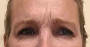 Botox® Before and After Pictures Bucks County, PA and Hunterdon County, NJ