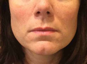 Dermal Fillers and Injectables Before and After Pictures Bucks County, PA and Hunterdon County, NJ