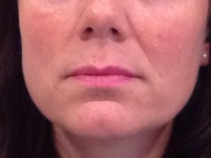 Dermal Fillers and Injectables Before and After Pictures Bucks County, PA and Hunterdon County, NJ