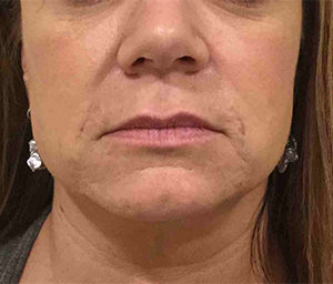 Dermapen® Before and After Pictures Bucks County, PA and Hunterdon County, NJ