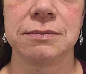 Dermapen® Before and After Pictures Bucks County, PA and Hunterdon County, NJ