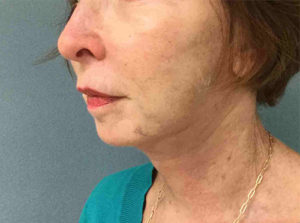 Facelift Before and After Pictures Bucks County, PA and Hunterdon County, NJ