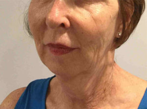 Facelift Before and After Pictures Bucks County, PA and Hunterdon County, NJ