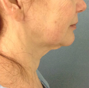 Facelift Before and After Pictures Bucks County, PA and Hunterdon County, NJ