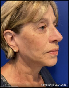 Facelift Before and After Pictures Bucks County, PA and Hunterdon County, NJ