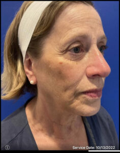 Facelift Before and After Pictures Bucks County, PA and Hunterdon County, NJ