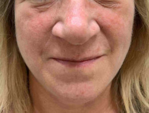 Laser Skin Resurfacing Before and After Pictures Bucks County, PA and Hunterdon County, NJ