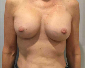 Breast Augmentation Before and After Pictures Bucks County, PA and Hunterdon County, NJ