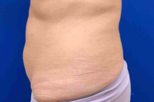 Coolsculpting Before and After Pictures Bucks County, PA and Hunterdon County, NJ