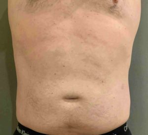 Coolsculpting Before and After Pictures Bucks County, PA and Hunterdon County, NJ