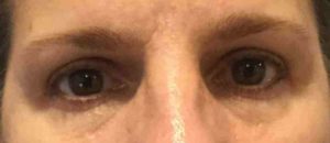 Blepharoplasty Before and After Pictures Bucks County, PA and Hunterdon County, NJ
