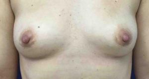 Breast Implant Removal Before and After Pictures Bucks County, PA, and Hunterdon County, NJ