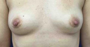 Breast Implant Removal Before and After Pictures Bucks County, PA and Hunterdon County, NJ