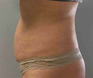 Coolsculpting Before and After Pictures Bucks County, PA and Hunterdon County, NJ