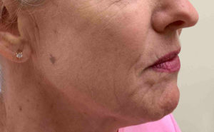 Tempsure Skin Tightening Before and After Pictures Bucks County, PA and Hunterdon County, NJ