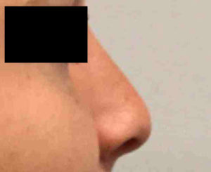 Rhinoplasty Before and After Pictures Bucks County, PA and Hunterdon County, NJ