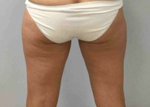 Coolsculpting Before and After Pictures in Bucks County, PA, and Hunterdon County, NJ