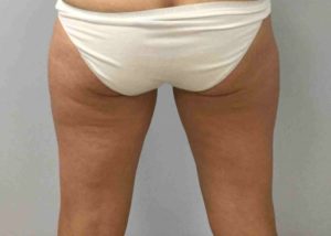 Coolsculpting Before and After Pictures Bucks County, PA and Hunterdon County, NJ