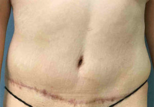 Tummy Tuck Before and After Pictures Bucks County, PA and Hunterdon County, NJ