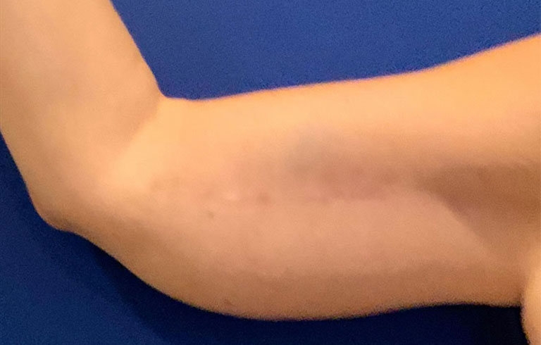 Before and after: brachioplasty