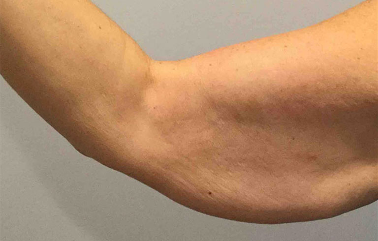 Before and after: brachioplasty