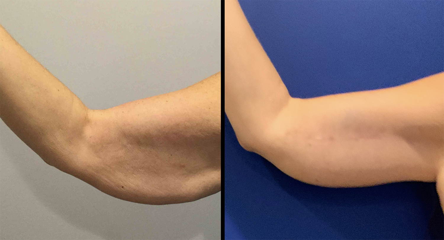 Arm Lift (Brachioplasty) Before and After Pictures Bucks County, PA and Hunterdon County, NJ