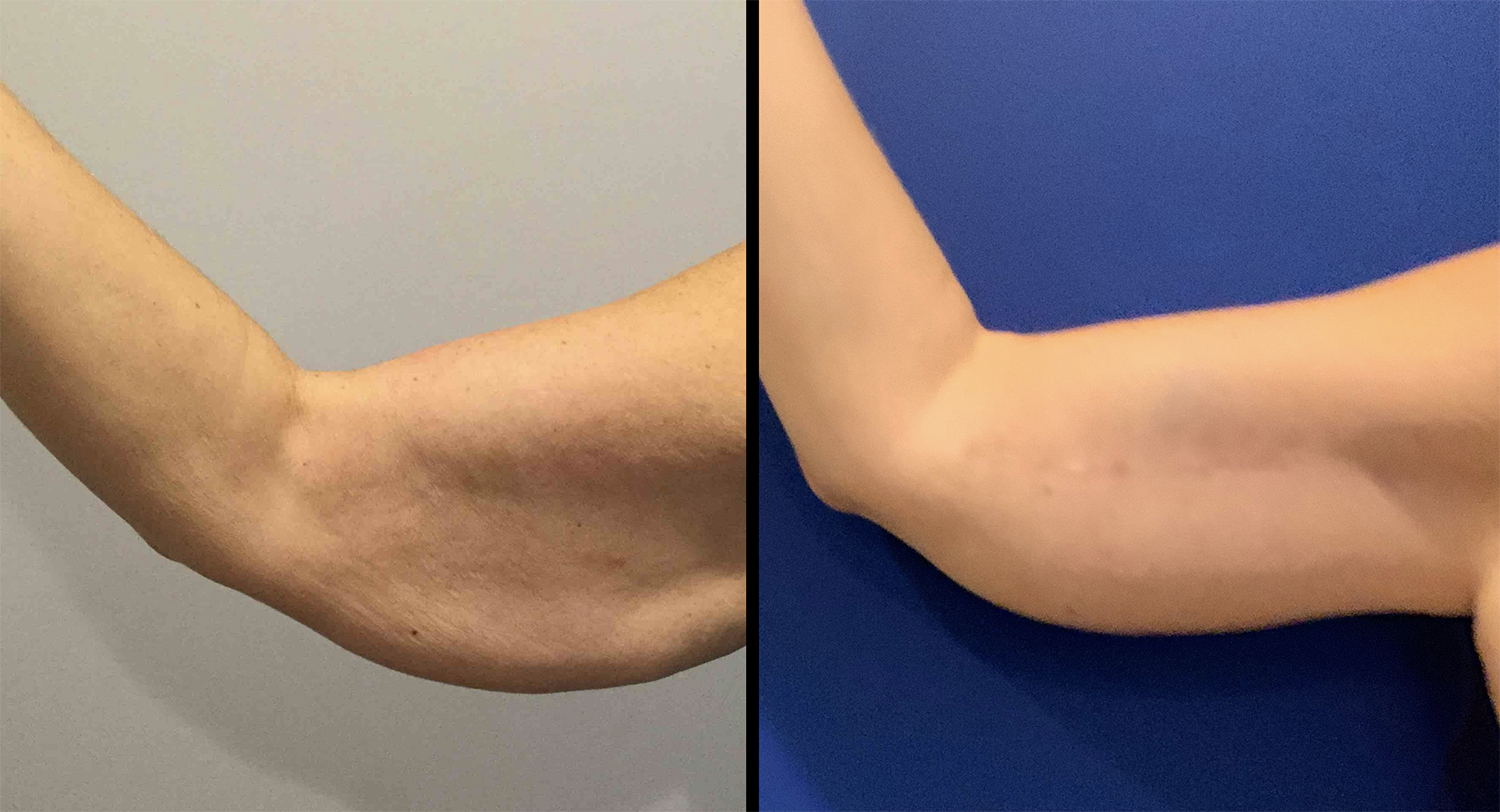ArmLift Arm Lift (Brachioplasty) Before and After Pictures Bucks County, PA and Hunterdon County, NJ