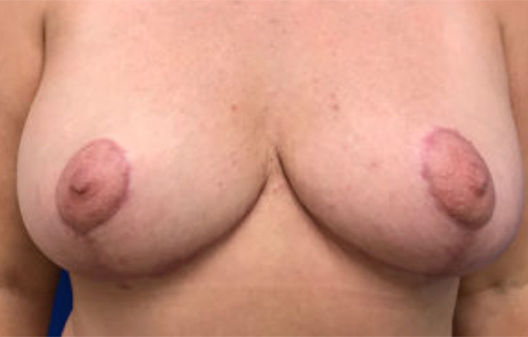 Before and after: breast lift