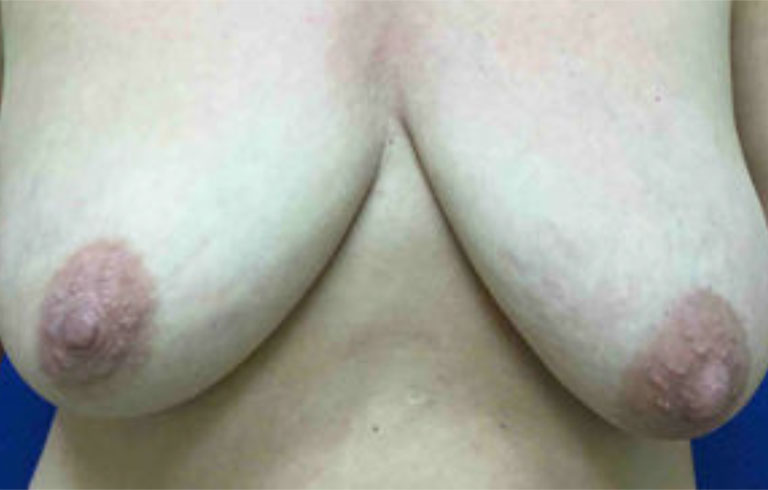 Before and after: breast lift