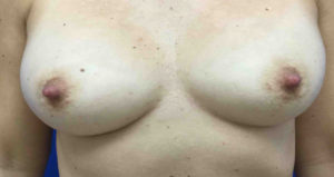 Breast Implant Removal Before and After Pictures Bucks County, PA and Hunterdon County, NJ