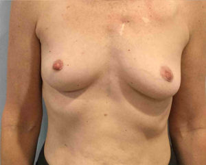 Breast Augmentation Before and After Pictures Bucks County, PA and Hunterdon County, NJ