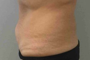 Coolsculpting Before and After Pictures Bucks County, PA and Hunterdon County, NJ