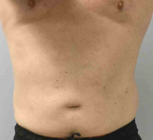 Coolsculpting Before and After Pictures Bucks County, PA and Hunterdon County, NJ