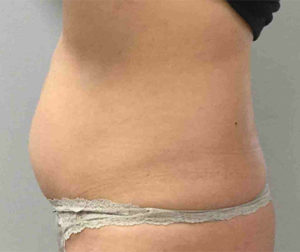 Coolsculpting Before and After Pictures Bucks County, PA and Hunterdon County, NJ