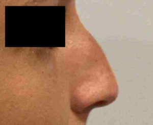 Rhinoplasty Before and After Pictures Bucks County, PA, and Hunterdon County, NJ