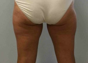 Coolsculpting Before and After Pictures Bucks County, PA and Hunterdon County, NJ