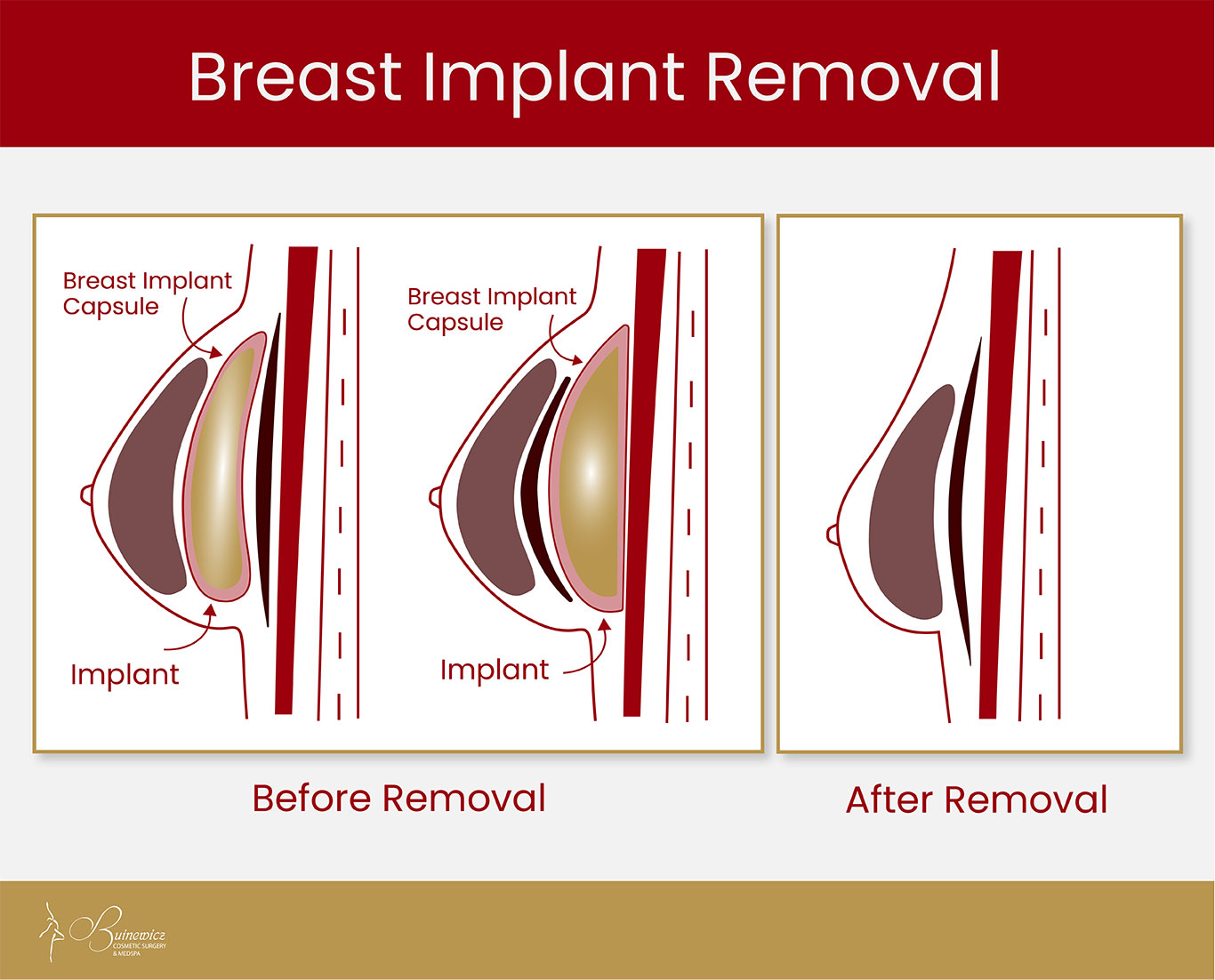BUI_GE_2024 Breast Implant Removal
