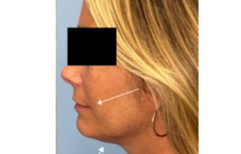 Before and after: Sofwave